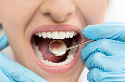 How to maintain strong tooth enamel blog thumbnail at Dentist of Gardena